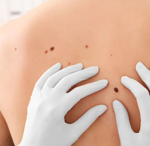 Best Sarcoma Cancer treatment in Mumbai